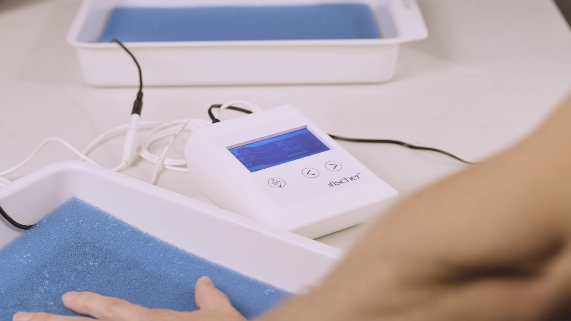 Image: A person undergoing palmar hyperhidrosis treatment by using RA Fischer Co.'s "The Fischer," the original metal-free iontophoresis device specifically designed for addressing excessive sweating of the hands.