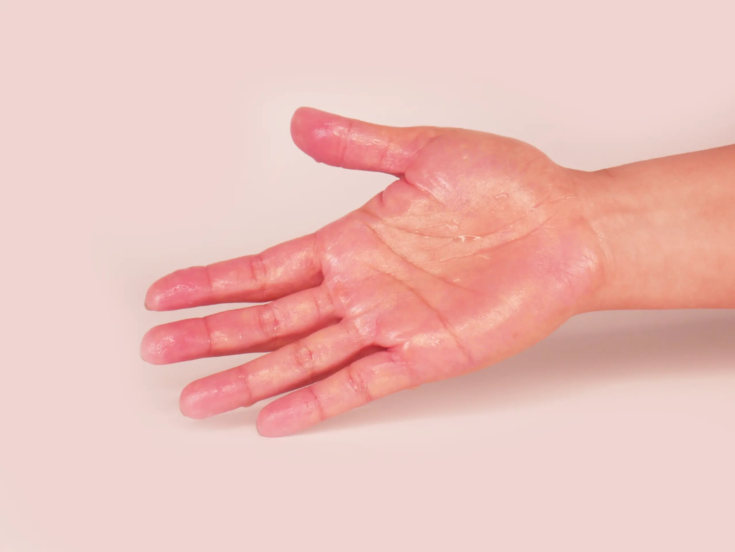 Close up image of a hand of a person who has hyperhidrosis. Hand covered in sweat. Pale pink background